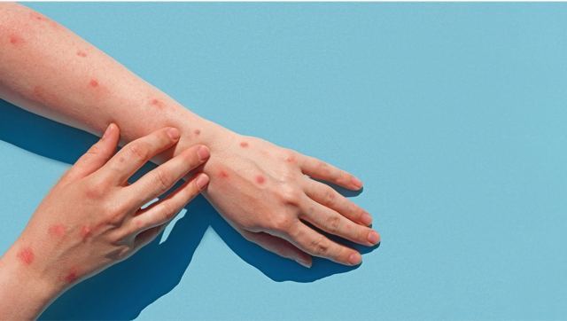 ΕΟΔΥ: Ακόμη 4 κρούσματα ευλογιάς των πιθήκων στη χώρα μας