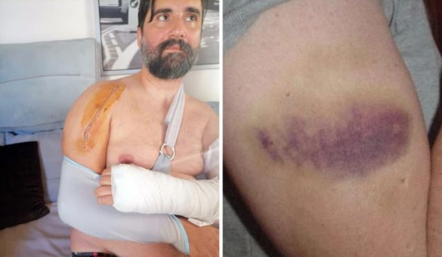 Σοκάρουν οι φωτογραφίες από τον ξυλοδαρμό διασώστη του ΕΚΑΒ: «Λεπτή η γραμμή μεταξύ ζωής και θανάτου» - Τι καταγγέλλει