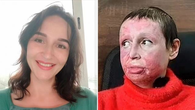 Ρωσία: 33χρονος βασάνισε 40χρονη αφού τον χώρισε - Τη «σταύρωσε» και της έβαλε φωτιά