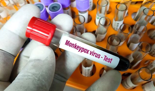 Ευλογιά των Πιθήκων: 13 περιστατικά στην Ελλάδα – Χαμηλός ο κίνδυνος για τον γενικό πληθυσμό