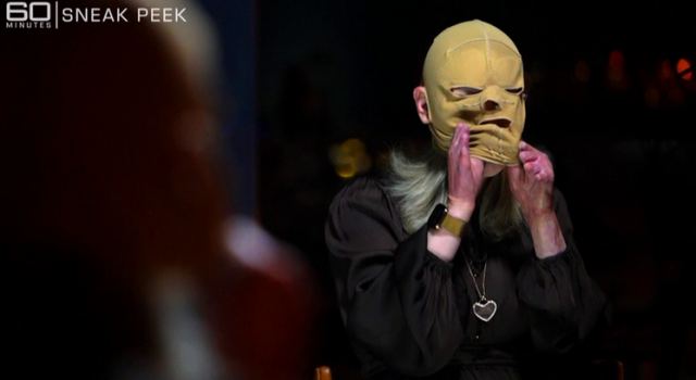 Η στιγμή που βγάζει τη μάσκα μία γυναίκα με εγκαύματα από έκρηξη ηφαιστείου και πόσο όμορφη είναι