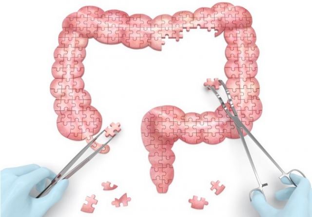 Καρκίνος Παχέος Εντέρου: Ο προληπτικός έλεγχος που σώζει ζωές