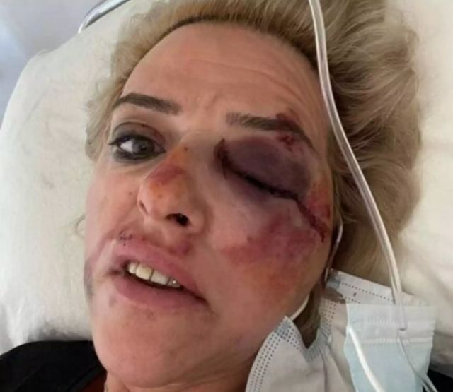 Καλαμάτα: Αδέσποτα σκυλιά έριξαν τη γυναίκα οδηγό από τη μηχανή και την σακάτεψαν – Σοκάρουν οι εικόνες