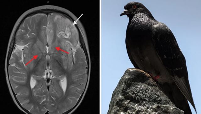 Κοριτσάκι δύο ετών πέθανε από σπάνιο ιό περιστεριών – «Είναι μόλις το πέμπτο πρόσωπο που γνωρίζουμε ότι πέθανε από αυτό»