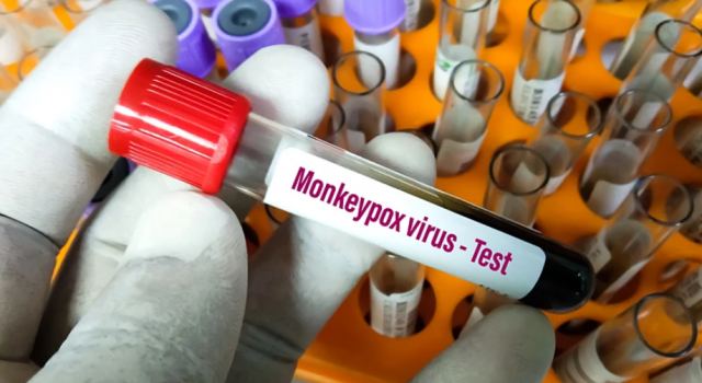 Ευλογιά των πιθήκων: Επιβεβαιώθηκε το στέλεχος Monkeypox στο πρώτο κρούσμα στην Ελλάδα