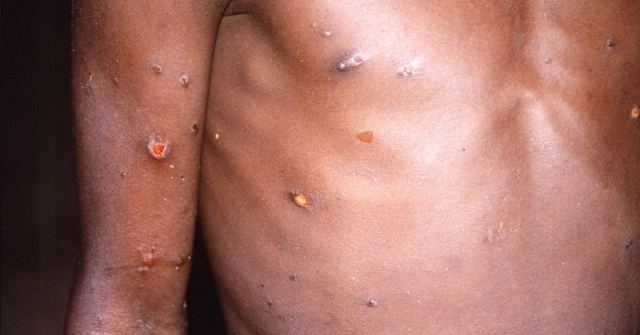 Ο ΕΟΔΥ για την ευλογιά των πιθήκων - Πως μεταδίδεται από άνθρωπο σε άνθρωπο