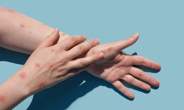 Ακόμη τρεις άνδρες με ευλογιά των πιθήκων