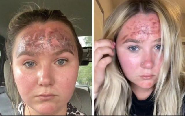 To αντηλιακό είχε λήξει και τα εγκαύματα που έπαθε ήταν φριχτά