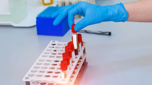 Ερευνητές ανέπτυξαν την πρώτη εξέταση αίματος που μπορεί να διαγνώσει ορισμένους τύπους καρκίνου του εγκεφάλου