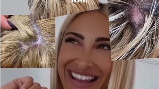 Ιωάννα Τούνη: Αποκάλυψε ότι πάσχει από γυροειδή αλωπεκία - 