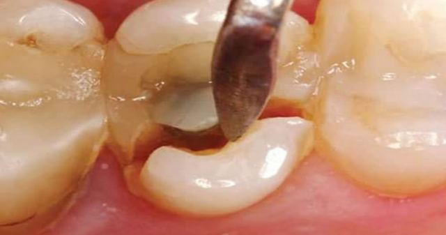 Τι πρέπει να κάνω για έναν γομφίο που έχει σπάσει στη γραμμή των ούλων