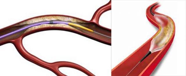 Τι είναι το ιατρικό μπαλονάκι και η χρήση του εκτός της καρδιάς