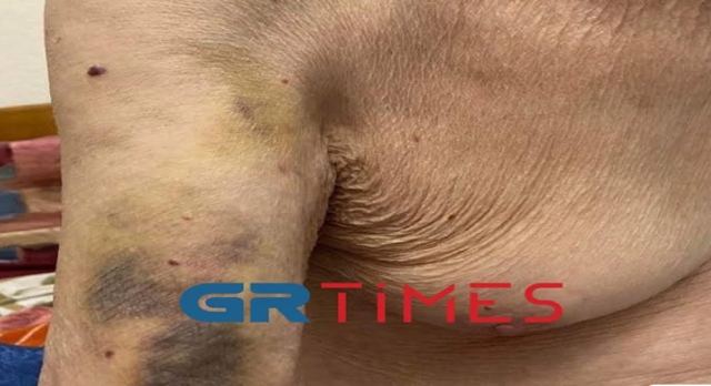 Θεσσαλονίκη: «Προτιμώ να πεθάνω στο σπίτι μου» λέει ο 98χρονος που φέρεται να ξυλοκοπήθηκε στο Παπαγεωργίου