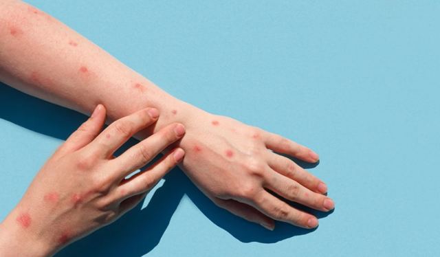 Τουρκία: Πρώτο κρούσμα ευλογιάς πιθήκων σε 37χρονο άνδρα