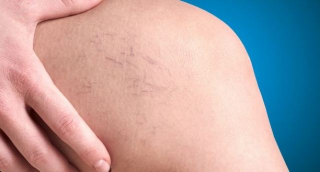 Νέες μέθοδοι θεραπείας αιμορροΐδων, ευρυαγγειών και κιρσών στη Λαμία