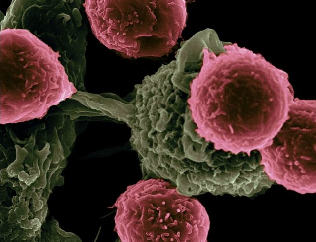 SOS από ειδικούς: Αντιμέτωπη με «επιδημία καρκίνου» η Ευρώπη τα επόμενα χρόνια