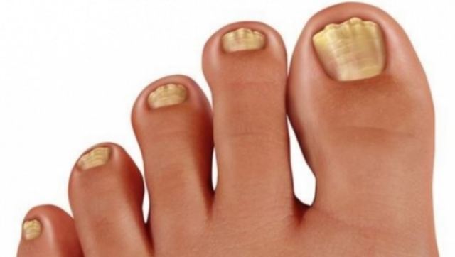 Τα λάθη που κάνετε και βγάζετε μύκητες στα νύχια - Τι να προσέχετε