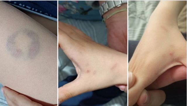 Άρτα: Διευθύντρια σχολείου δάγκωσε 11χρονο μαθητή ΑΜΕΑ