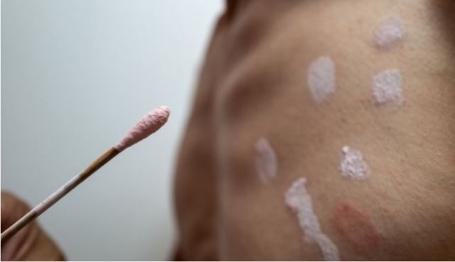 Ευλογιά των πιθήκων: Εξαπλώνεται στην Ευρώπη - Σε 