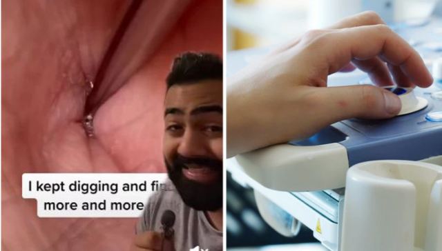 Γιατρός του TikTok αποκαλύπτει τι βρήκε μέσα σε αφαλό ασθενή του - Τουλάχιστον 67 είδη βακτηρίων στην περιοχή