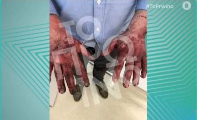 Τζώρτζης Μονογυιός: Σοκάρουν οι εικόνες με τα εγκαύματα του φίλου του που τον απεγκλώβισε από τη Ferrari