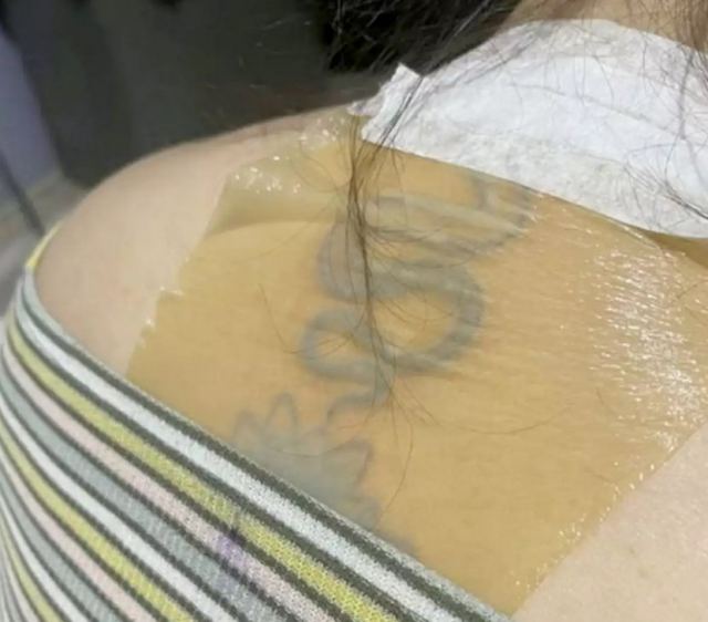 Αγνόησε τις οδηγίες και έκανε ηλιοθεραπεία – Το τατουάζ της φούσκωσε