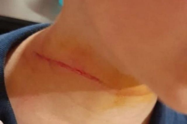 Κρήτη: 7χρονος παραλίγο να πνιγεί με λουρί σκύλου – Σοκάρουν οι φωτογραφίες από τον τραυματισμό του